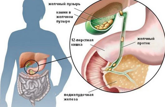 Öd kisəsində daşlar BU SƏBƏBLƏRƏ GÖRƏ əmələ gəlir 