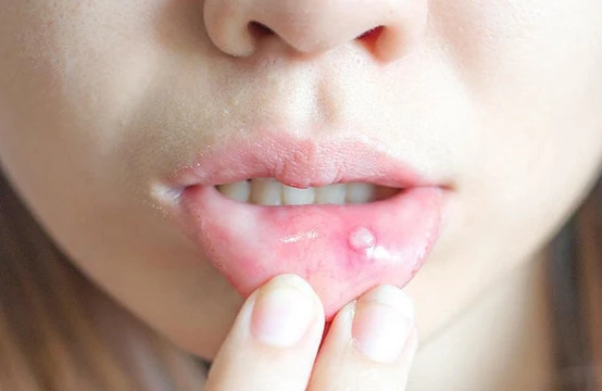 Ağızdakı yaraları bu yolla müalicə etmək olar