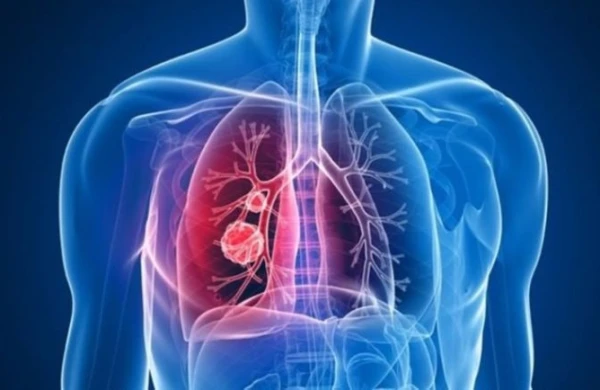 Vərəm nədən yaranır?