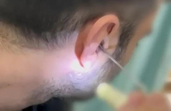 Narkotiki qulağında gizlədibmiş&nbsp; &nbsp;—&nbsp; FOTOLAR