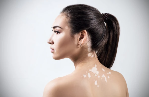 Səbəbi bilinməyən və müalicəsi olmayan XƏSTƏLİK