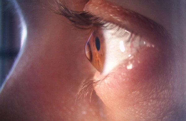 “Sadə damcı” təhlükəsi – göz qızartısını gizlədən ciddi risk&nbsp;&nbsp;