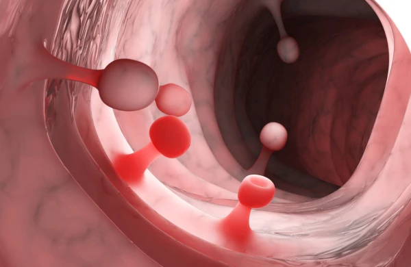 Öddə polip nə zaman əməliyyat tələb edir? – Həkimdən açıqlama&nbsp;&nbsp;