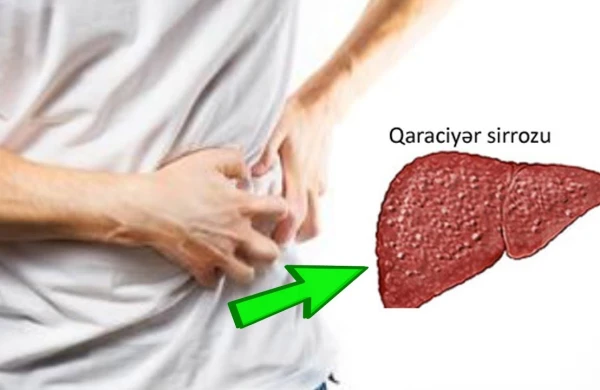 Sirroz necə yaranır və niyə təhlükəlidir? –    Mütəxəssis açıqlayır&nbsp;&nbsp;