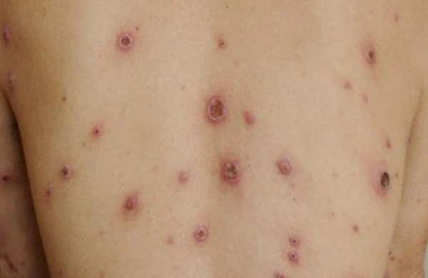 Siflis necə müalicə olunur?    —   HƏKİM AÇIQLADI