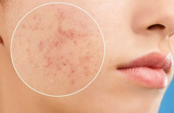 Akne nə zaman yaranır?