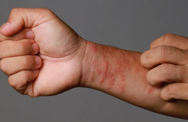 Ekzema zamanı&nbsp; dəriyə qulluq&nbsp; NECƏ EDİLMƏLİDİR?