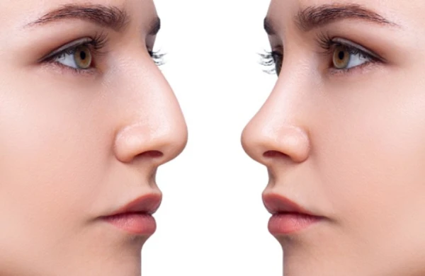 Burun əməliyyatı hansı hallarda pulsuz OLACAQ?&nbsp; &nbsp;—&nbsp; EKSPERTLƏ MÜZAKİRƏ