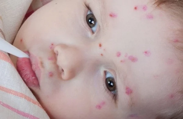 Qızılca ilə bağlı pediatr XƏBƏRDARLIQ EDİR