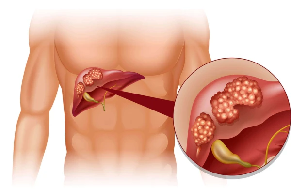 Vitamin D qaraciyərə necə təsir edir?&nbsp;&nbsp;