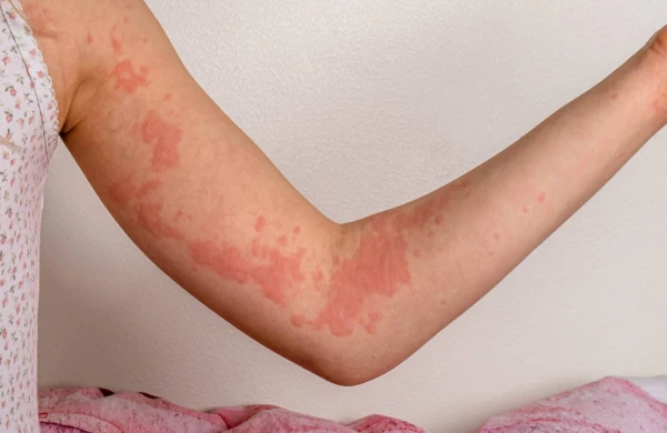 Övrə xəstəliyi nədən yaranır?