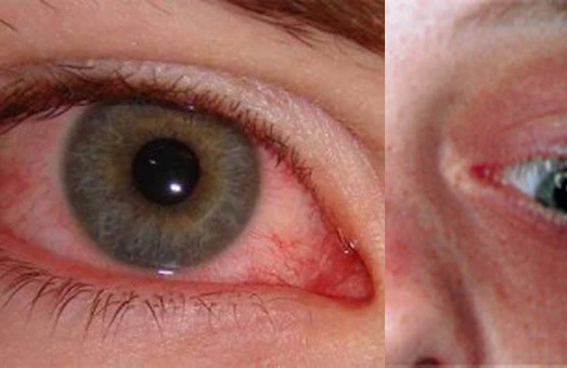 “Uşaqlarda herpes riski: yaşlı insanlarla yaxın təmas niyə təhlükəli ola bilər?” – Benjamin Kərimovun açıqlaması&nbsp;&nbsp;