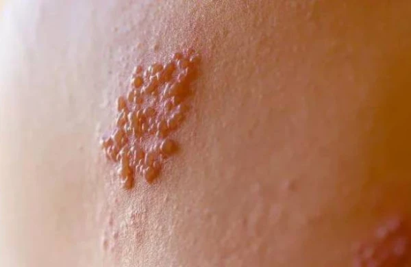 Genital herpesin simptomları AÇIQLANDI