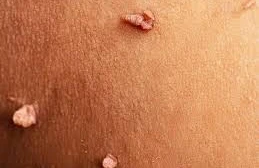 Verruka Anogenitalis nədir?&nbsp;&nbsp;