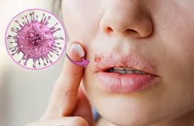 Herpes tam sağalırmı? – Həkimdən vacib açıqlama&nbsp;&nbsp;