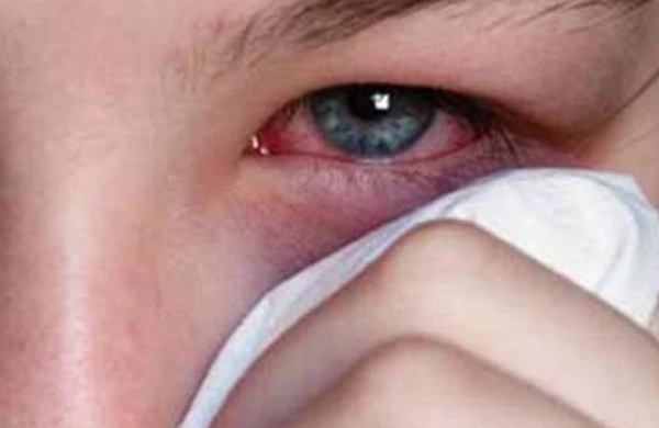 Göz allergiyası tam müalicə olunurmu? – Həkimdən vacib AÇIQLAMA&nbsp;&nbsp;