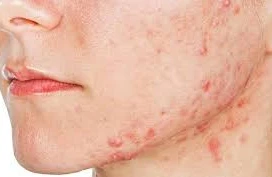 Dermatoloq: “Aknə ilə bağlı yanlış bilinən bir çox fikir var”
