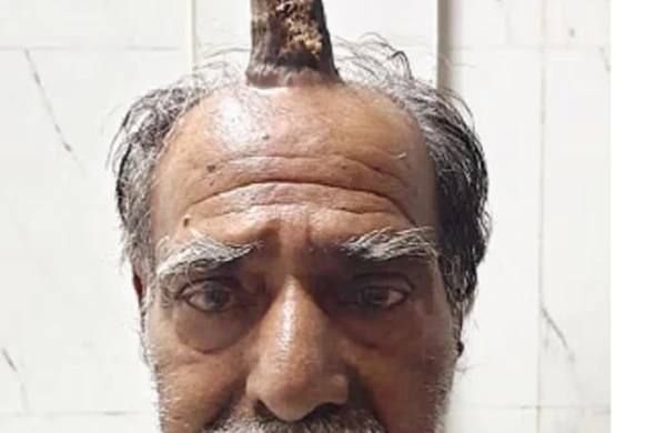 74 yaşlı kişinin başında “buynuz" çıxdı - FOTO&nbsp;&nbsp;