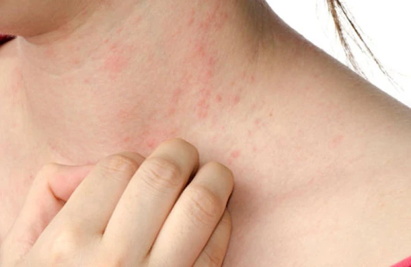 Allergiyanı birdəfəlik müalicə etmək mümkündür? – Həkim açıqladı