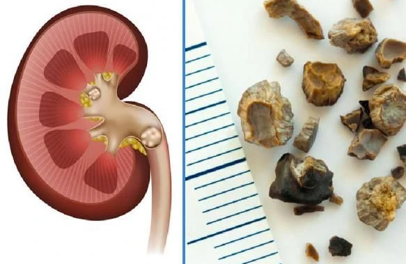 Uroloq AÇIQLADI: Ağrı verməyən daş ciddi riskdir