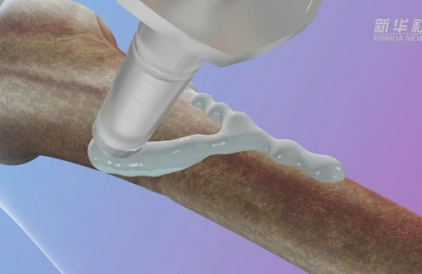Təbabətdə İNQİLAB: Elm adamları sınıq sümükləri bərpa edən tibbi yapışdırıcı icad etdilər&nbsp;&nbsp;