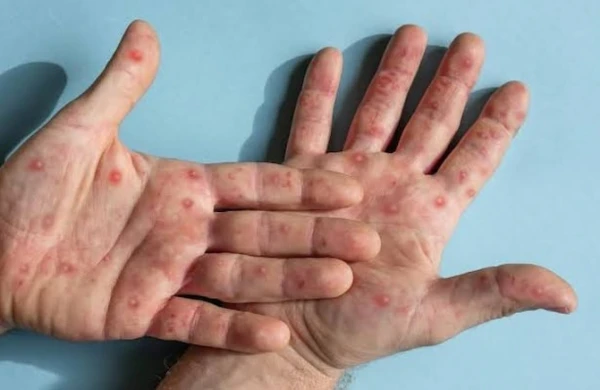 Kabus geri döndü: Epidemiya 3 ölkəyə yayıldı