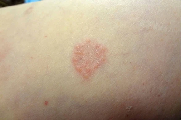 Qranuloma Anulare nədir ?&nbsp;&nbsp;
