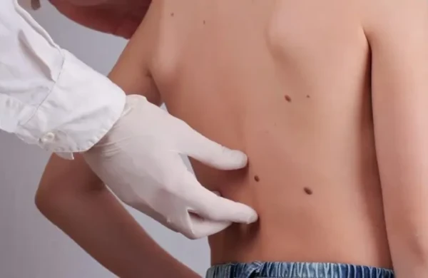 Dəridəki xallara toxunmaq təhlükəlidirmi? – Dermatoloqdan XƏBƏRDARLIQ
