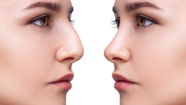 Burun əməliyyatı hansı hallarda pulsuz OLACAQ?   —  EKSPERTLƏ MÜZAKİRƏ