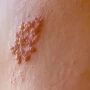Genital herpesin simptomları AÇIQLANDI