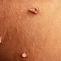 Verruka Anogenitalis nədir?&nbsp;&nbsp;