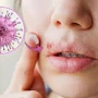 Herpes tam sağalırmı? – Həkimdən vacib açıqlama&nbsp;&nbsp;