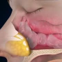 Burunda polip olanda bu əlamətlər yaranır -LOR XƏBƏRDARLIQ EDİR