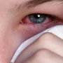 Göz allergiyası tam müalicə olunurmu? – Həkimdən vacib AÇIQLAMA&nbsp;&nbsp;
