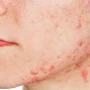 Dermatoloq: “Aknə ilə bağlı yanlış bilinən bir çox fikir var”