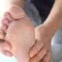 Dermatoloqlardan göbələklə bağlı XƏBƏRDARLIQ
