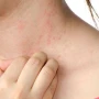 Allergiyanı birdəfəlik müalicə etmək mümkündür? – Həkim açıqladı