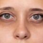 Göz ətrafı qaralma nədən olur?