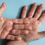 Kabus geri döndü: Epidemiya 3 ölkəyə yayıldı