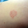 Qranuloma Anulare nədir ?&nbsp;&nbsp;