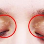 Ksanatelazma nədir?