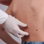 Dəridəki xallara toxunmaq təhlükəlidirmi? – Dermatoloqdan XƏBƏRDARLIQ